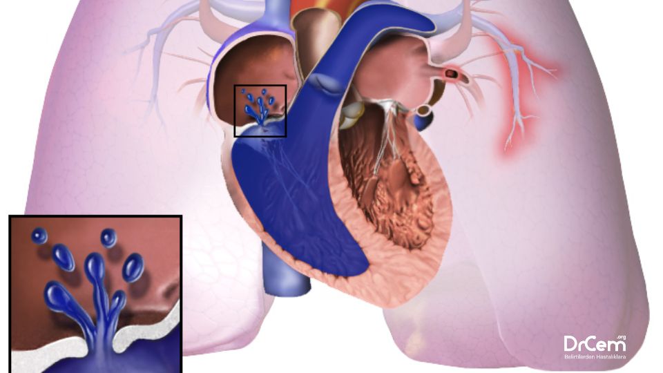 Pulmoner Hipertansiyon görseli - DrCem hastalık rehberi